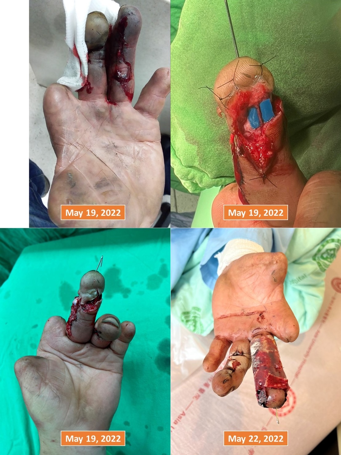 經由顯微血管縫合手術將血管重新接回，順利救回斷指。 （亞大醫院提供）